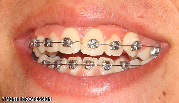 Progresión de la ortodoncia después de 7 meses