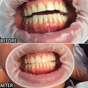 Odontología cosmética antes y después