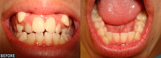 Ortodoncia antes